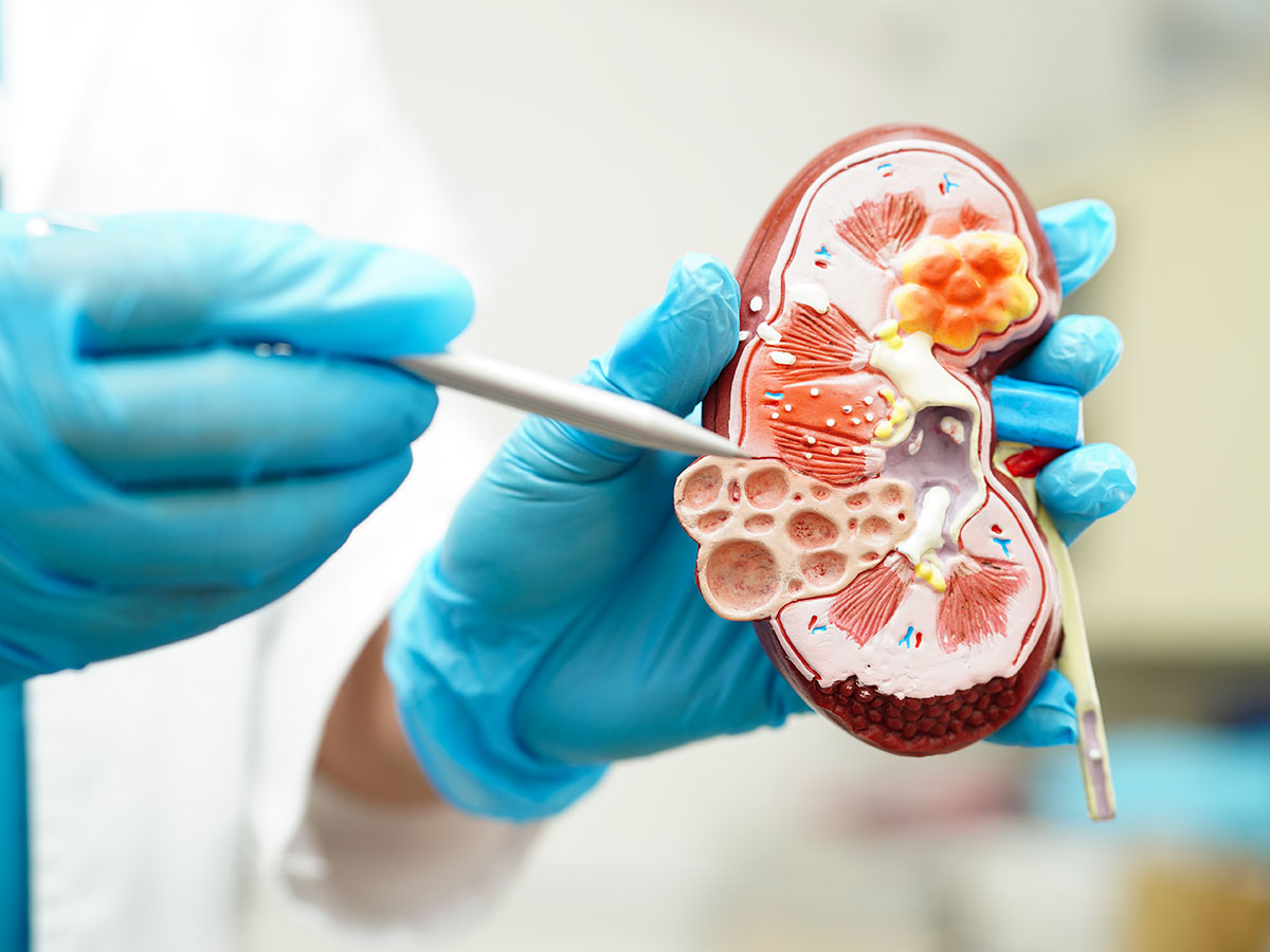 Kidney Stone Relief: Latest Removal Methods