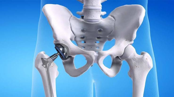 Hip Replacement Surgery: What Patients Should Know Before Taking the Next Step