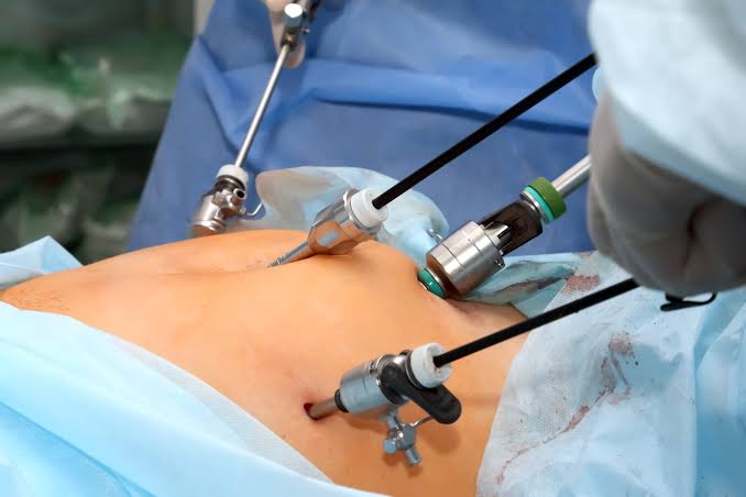Laparoscopic Surgery: What Is It and How Does It Work?